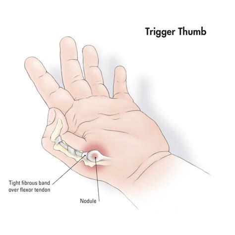 Sådan repareres Trigger Thumb